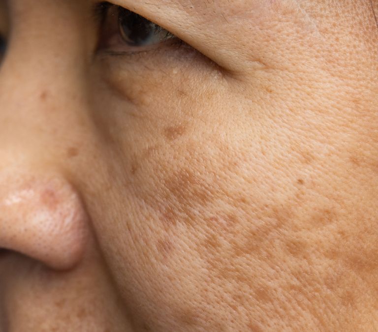 How Your Skin Changes With Menopause And How to Deal With It 1