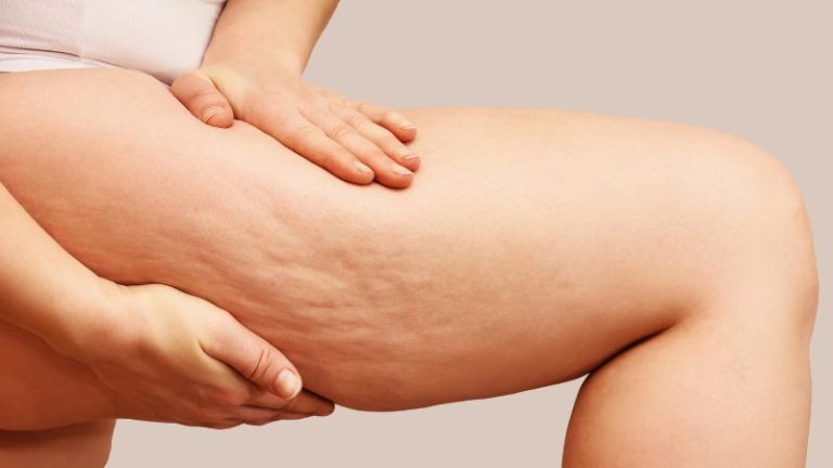 liposuction for cellulite reduction 768x432